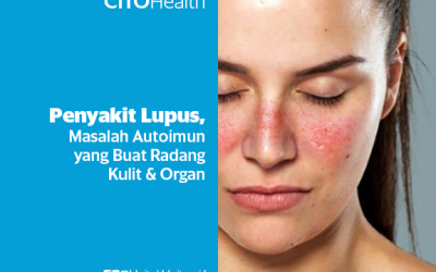 Penyakit Lupus, Masalah Autoimun yang Sebabkan Peradangan Kulit & Organ