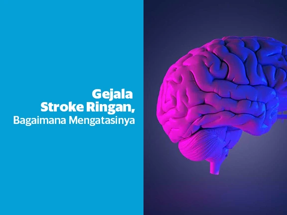 Gejala Stroke Ringan dan Bagaimana Mengatasinya