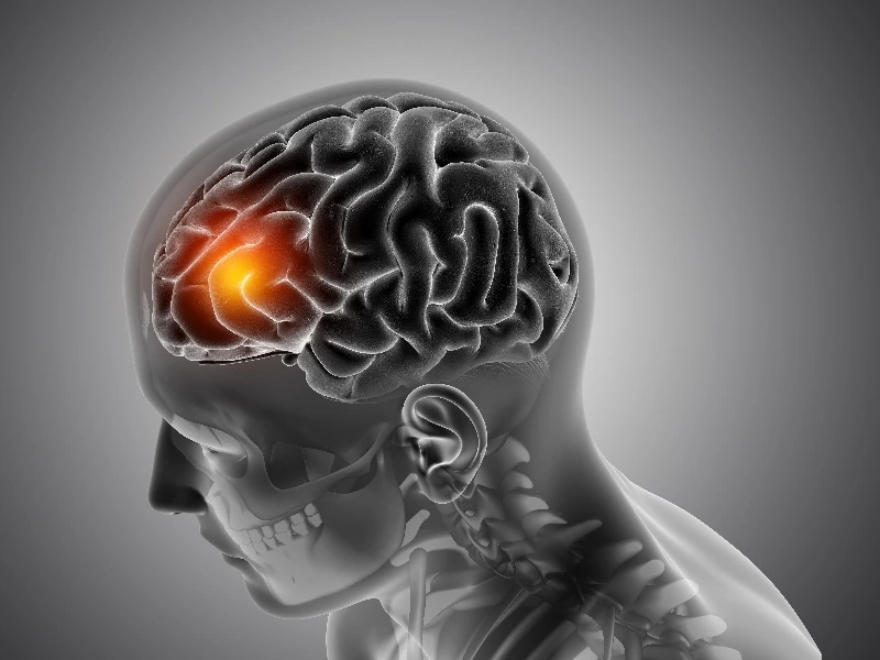 Stroke Bisa Menyerang Orang yang Berusia di Bawah 40 tahun